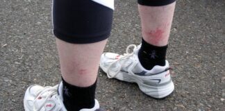 Erupción del golfista: vasculitis inducida por el ejercicio